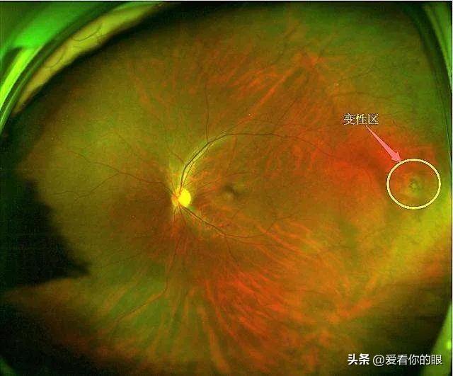 视网膜色素变性治疗最新进展揭秘