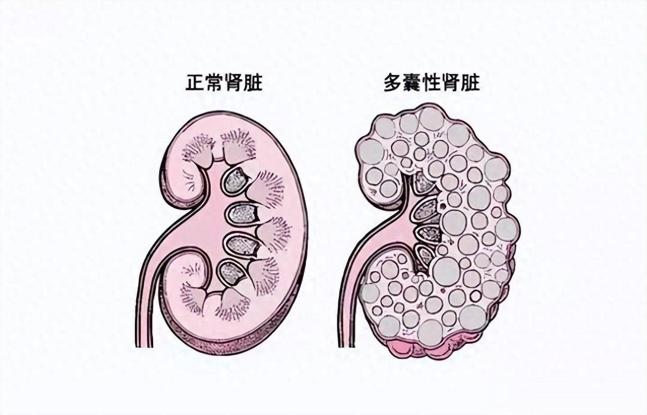 多囊肾最新治疗方法，希望之光引领患者前行之路