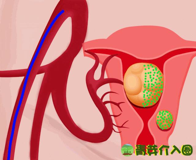 子宫肌瘤最新最有效的治疗方法揭秘